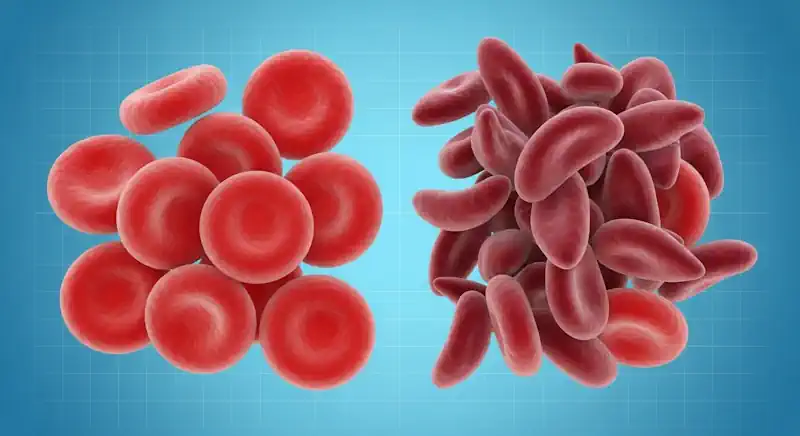 An illustration comparing healthy round red blood cells to the crescent shape of sickle cells.